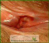 sphincterotomy